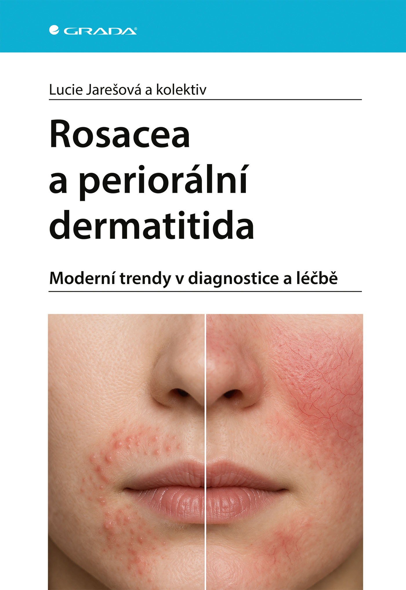 Rosacea a periorální dermatitida